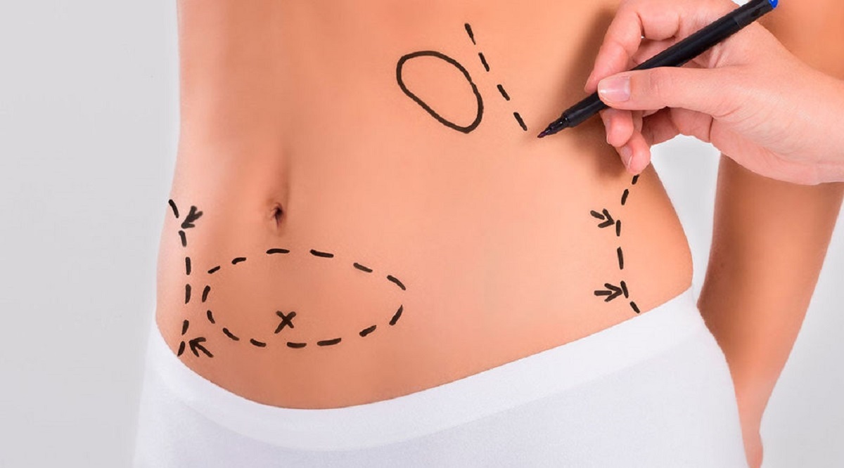 Abdominoplastia ou lipoaspiração? Abdominoplastia ou lipoaspiração?